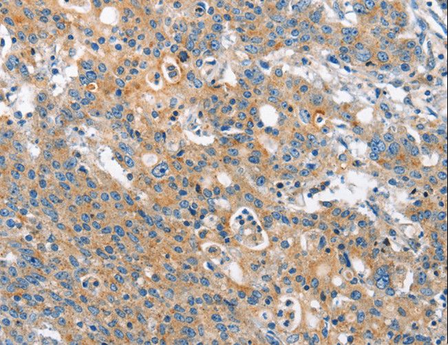 CHMP1A Antibody - Immunohistochemistry of paraffin-embedded Human gastric cancer using CHMP1A Polyclonal Antibody at dilution of 1:60.