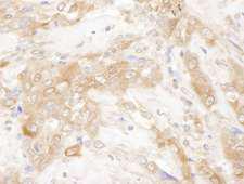CHMP2B Antibody - Detection of human CHMP2B by immunohistochemistry. Sample: FFPE section of human breast carcinoma. Antibody: Affinity purified rabbit anti- CHMP2B used at a dilution of 1:1,000 (1µg/ml). Detection: DAB. Counterstain: IHC Hematoxylin (blue).