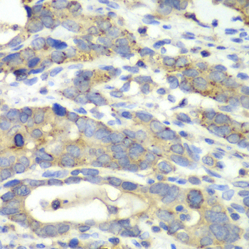 CHMP2B Antibody - Immunohistochemistry of paraffin-embedded human gastric cancer tissue.