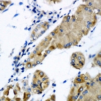 CHMP2B Antibody - Immunohistochemical analysis of CHMP2B staining in human gastric cancer formalin fixed paraffin embedded tissue section. The section was pre-treated using heat mediated antigen retrieval with sodium citrate buffer (pH 6.0). The section was then incubated with the antibody at room temperature and detected using an HRP conjugated compact polymer system. DAB was used as the chromogen. The section was then counterstained with hematoxylin and mounted with DPX.