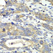 CHMP2B Antibody - Immunohistochemistry of paraffin-embedded human gastric cancer using CHMP2B antibody at dilution of 1:100 (40x lens).