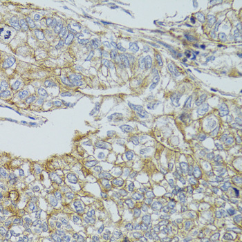 CHMP4B Antibody - Immunohistochemistry of paraffin-embedded human gastric cancer tissue.