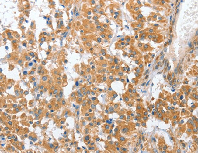 CHMP4B Antibody - Immunohistochemistry of paraffin-embedded Human liver cancer using CHMP4B Polyclonal Antibody at dilution of 1:40.