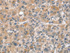CHMP4B Antibody - Immunohistochemistry of paraffin-embedded Human thyroid cancer using CHMP4B Polyclonal Antibody at dilution of 1:40.
