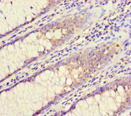 CHMP4C Antibody - Immunohistochemistry of paraffin-embedded human colon cancer at dilution of 1:100