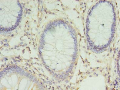 CHMP6 Antibody - Immunohistochemistry of paraffin-embedded human colon cancer using antibody at dilution of 1:100.