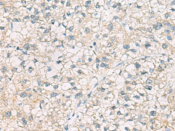 CHMP6 Antibody - Immunohistochemistry of paraffin-embedded Human liver cancer tissue  using CHMP6 Polyclonal Antibody at dilution of 1:65(×200)