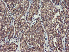 CHN1 Antibody - IHC of paraffin-embedded Carcinoma of Human thyroid tissue using anti-CHN1 mouse monoclonal antibody.