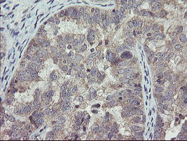 CHN1 Antibody - IHC of paraffin-embedded Adenocarcinoma of Human ovary tissue using anti-CHN1 mouse monoclonal antibody.