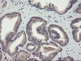 CHN1 Antibody - IHC of paraffin-embedded Carcinoma of Human prostate tissue using anti-CHN1 mouse monoclonal antibody.