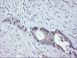 CHN1 Antibody - IHC of paraffin-embedded Adenocarcinoma of Human colon tissue using anti-CHN1 mouse monoclonal antibody. (Heat-induced epitope retrieval by 10mM citric buffer, pH6.0, 100C for 10min).