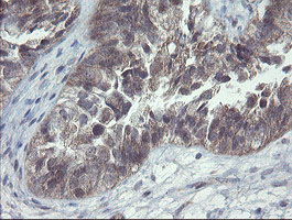 CHN1 Antibody - IHC of paraffin-embedded Adenocarcinoma of Human ovary tissue using anti-CHN1 mouse monoclonal antibody. (Heat-induced epitope retrieval by 10mM citric buffer, pH6.0, 100C for 10min).