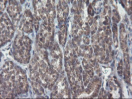 CHN1 Antibody - IHC of paraffin-embedded Carcinoma of Human thyroid tissue using anti-CHN1 mouse monoclonal antibody. (Heat-induced epitope retrieval by 10mM citric buffer, pH6.0, 100C for 10min).