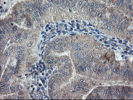 CHN1 Antibody - IHC of paraffin-embedded Adenocarcinoma of Human endometrium tissue using anti-CHN1 mouse monoclonal antibody. (Heat-induced epitope retrieval by 10mM citric buffer, pH6.0, 100C for 10min).