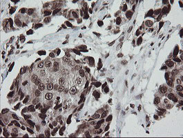 CHN1 Antibody - IHC of paraffin-embedded Adenocarcinoma of Human breast tissue using anti-CHN1 mouse monoclonal antibody. (Heat-induced epitope retrieval by 10mM citric buffer, pH6.0, 100C for 10min).