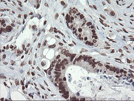 CHN1 Antibody - IHC of paraffin-embedded Adenocarcinoma of Human colon tissue using anti-CHN1 mouse monoclonal antibody. (Heat-induced epitope retrieval by 10mM citric buffer, pH6.0, 100C for 10min).