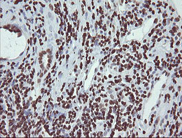 CHN1 Antibody - IHC of paraffin-embedded Carcinoma of Human kidney tissue using anti-CHN1 mouse monoclonal antibody. (Heat-induced epitope retrieval by 10mM citric buffer, pH6.0, 100C for 10min).