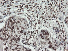 CHN1 Antibody - IHC of paraffin-embedded Carcinoma of Human lung tissue using anti-CHN1 mouse monoclonal antibody. (Heat-induced epitope retrieval by 10mM citric buffer, pH6.0, 100C for 10min).