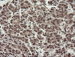 CHN1 Antibody - IHC of paraffin-embedded Carcinoma of Human liver tissue using anti-CHN1 mouse monoclonal antibody. (Heat-induced epitope retrieval by 10mM citric buffer, pH6.0, 100C for 10min).