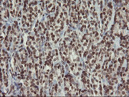 CHN1 Antibody - IHC of paraffin-embedded Carcinoma of Human thyroid tissue using anti-CHN1 mouse monoclonal antibody. (Heat-induced epitope retrieval by 10mM citric buffer, pH6.0, 100C for 10min).