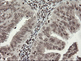 CHN1 Antibody - IHC of paraffin-embedded Adenocarcinoma of Human endometrium tissue using anti-CHN1 mouse monoclonal antibody. (Heat-induced epitope retrieval by 10mM citric buffer, pH6.0, 100C for 10min).