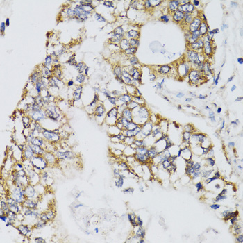 CHN1 Antibody - Immunohistochemistry of paraffin-embedded human gastric cancer tissue.