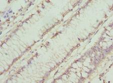 CHN1 Antibody - Immunohistochemistry of paraffin-embedded human colon cancer at dilution 1:100