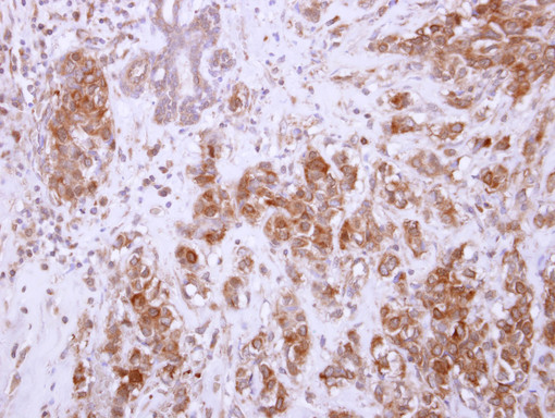 Chondroadherin / CHAD Antibody - IHC of paraffin-embedded Breast carcinoma, using CHAD antibody at 1:250 dilution.