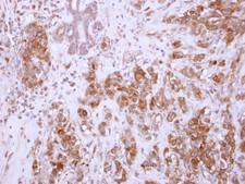 Chondroadherin / CHAD Antibody - IHC of paraffin-embedded Breast carcinoma, using CHAD antibody at 1:250 dilution.