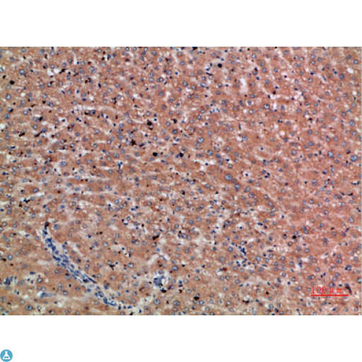 Chordin Antibody - Immunohistochemical analysis of paraffin-embedded human-liver-cancer, antibody was diluted at 1:200.