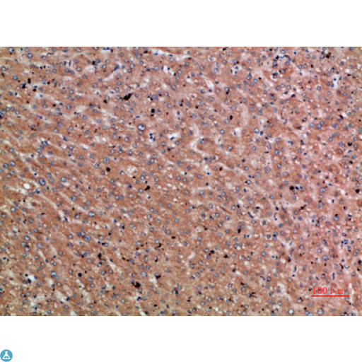 Chordin Antibody - Immunohistochemical analysis of paraffin-embedded human-liver-cancer, antibody was diluted at 1:200.