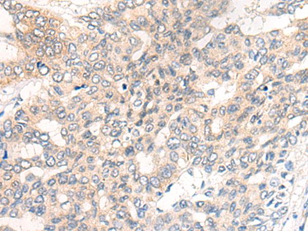 Chordin Antibody - Immunohistochemistry of paraffin-embedded Human liver cancer tissue  using CHRD Polyclonal Antibody at dilution of 1:40(×200)