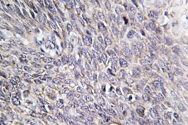 CHPF / CHSY2 Antibody - IHC of CHSY2 (R671) pAb in paraffin-embedded human cervix carcinoma tissue.