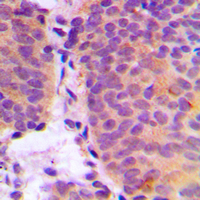 CHPF / CHSY2 Antibody - Immunohistochemical analysis of CHSY2 staining in human breast cancer formalin fixed paraffin embedded tissue section. The section was pre-treated using heat mediated antigen retrieval with sodium citrate buffer (pH 6.0). The section was then incubated with the antibody at room temperature and detected using an HRP conjugated compact polymer system. DAB was used as the chromogen. The section was then counterstained with hematoxylin and mounted with DPX.