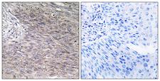 CHPF / CHSY2 Antibody - Peptide - + Immunohistochemistry analysis of paraffin-embedded human cervix carcinoma tissue using CHSS2 antibody.