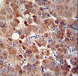CHRDL1 Antibody - CHRDL1 antibody immunohistochemistry of formalin-fixed and paraffin-embedded human hepatocarcinoma followed by peroxidase-conjugated secondary antibody and DAB staining.