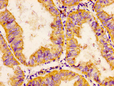 CHRDL1 Antibody - Immunohistochemistry image at a dilution of 1:200 and staining in paraffin-embedded human endometrial cancer performed on a Leica BondTM system. After dewaxing and hydration, antigen retrieval was mediated by high pressure in a citrate buffer (pH 6.0) . Section was blocked with 10% normal goat serum 30min at RT. Then primary antibody (1% BSA) was incubated at 4 °C overnight. The primary is detected by a biotinylated secondary antibody and visualized using an HRP conjugated SP system.