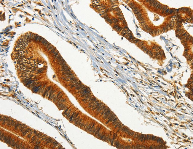 CHRDL2 Antibody - Immunohistochemistry of paraffin-embedded Human colon cancer using CHRDL2 Polyclonal Antibody at dilution of 1:20.