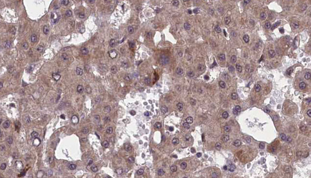CHRM5 / M5 Antibody - 1:100 staining human liver carcinoma tissues by IHC-P. The sample was formaldehyde fixed and a heat mediated antigen retrieval step in citrate buffer was performed. The sample was then blocked and incubated with the antibody for 1.5 hours at 22°C. An HRP conjugated goat anti-rabbit antibody was used as the secondary.