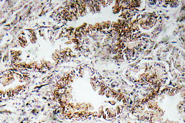 CHRNA1 Antibody - IHC of AChR1 (E217) pAb in paraffin-embedded human prostate carcinoma tissue.