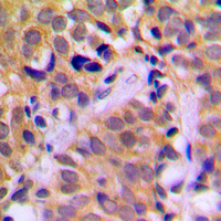 CHRNA1 Antibody - Immunohistochemical analysis of CHRNA1 staining in human prostate cancer formalin fixed paraffin embedded tissue section. The section was pre-treated using heat mediated antigen retrieval with sodium citrate buffer (pH 6.0). The section was then incubated with the antibody at room temperature and detected using an HRP conjugated compact polymer system. DAB was used as the chromogen. The section was then counterstained with hematoxylin and mounted with DPX.