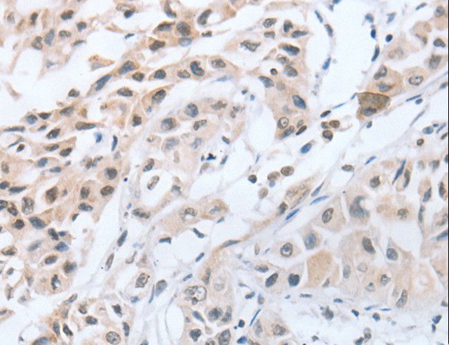 CHRNA10 Antibody - Immunohistochemistry of paraffin-embedded Human lung cancer using CHRNA10 Polyclonal Antibody at dilution of 1:50.