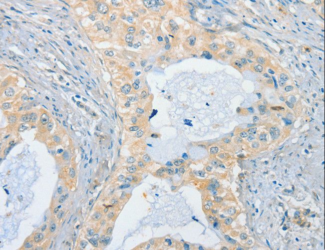 CHRNA2 Antibody - Immunohistochemistry of paraffin-embedded Human cervical cancer using CHRNA2 Polyclonal Antibody at dilution of 1:40.