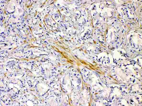 CHRNA5 Antibody - CHRNA5 was detected in paraffin-embedded sections of human prostatic cancer tissues using rabbit anti- CHRNA5 Antigen Affinity purified polyclonal antibody