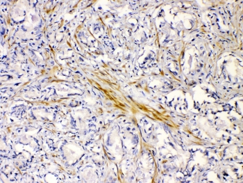 CHRNA5 Antibody - IHC testing of FFPE human prostate cancer tissue with CHRNA5 antibody at 1ug/ml. Required HIER: steam section in pH6 citrate buffer for 20 min and allow to cool prior to testing.