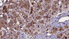 CHRNA5 Antibody - 1:100 staining human liver carcinoma tissues by IHC-P. The sample was formaldehyde fixed and a heat mediated antigen retrieval step in citrate buffer was performed. The sample was then blocked and incubated with the antibody for 1.5 hours at 22°C. An HRP conjugated goat anti-rabbit antibody was used as the secondary.