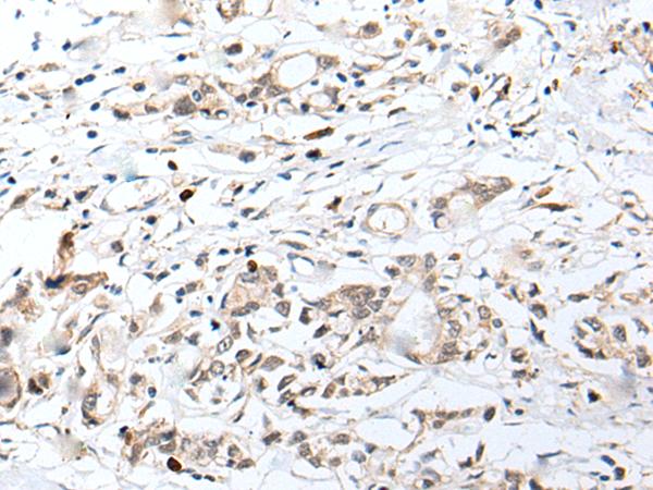 CHRNA5 Antibody - Immunohistochemistry of paraffin-embedded Human gastric cancer tissue  using CHRNA5 Polyclonal Antibody at dilution of 1:50(×200)