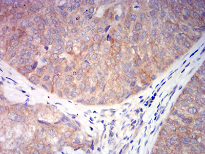 CHRNA6 Antibody - Immunohistochemical analysis of paraffin-embedded bladder cancer tissues using CHRNA6 mouse mAb with DAB staining.