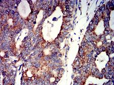 CHRNA7 Antibody - Immunohistochemical analysis of paraffin-embedded rectum cancer tissues using CHRNA7 mouse mAb with DAB staining.