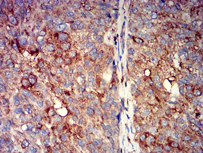 CHRNA7 Antibody - Immunohistochemical analysis of paraffin-embedded bladder cancer tissues using CHRNA7 mouse mAb with DAB staining.